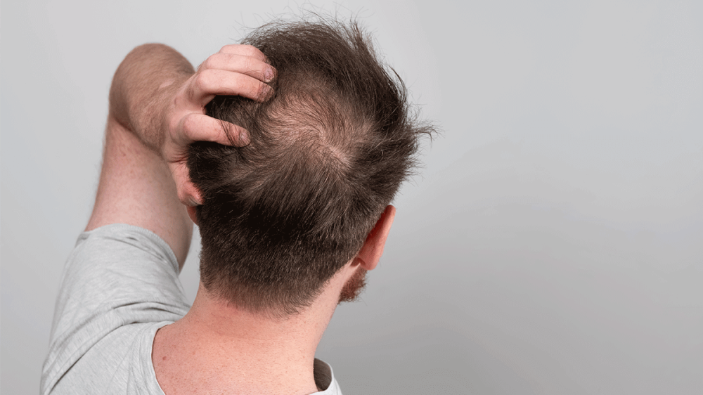 Da đầu không khỏe mạnh có thể làm gián đoạn chu kỳ phát triển của tóc, khiến tóc rụng nhiều hơn