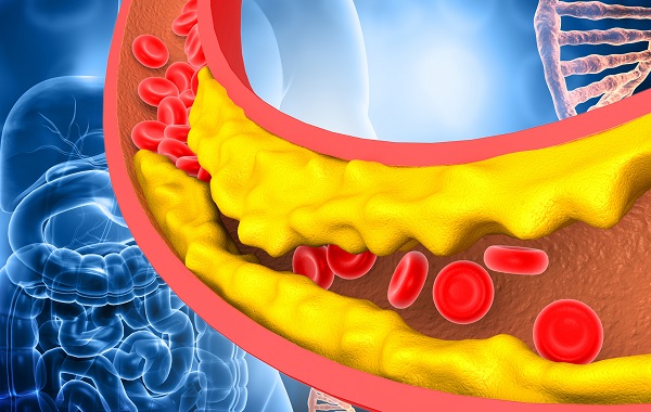 Kiểm soát LDL cholesterol không chỉ giúp phòng ngừa nguy cơ xơ vữa động mạch mà còn giúp phòng ngừa sa sút trí tuệ