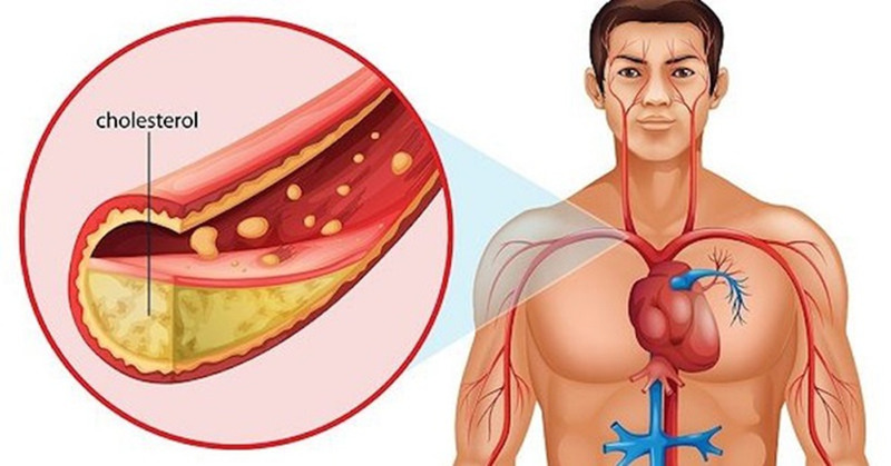 Mỡ máu cao gây ra biến chứng động mạch vành