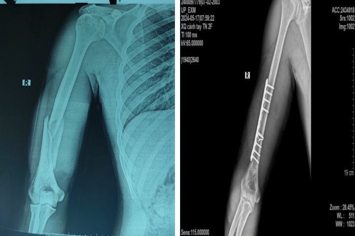 Hình ảnh X-quang cánh tay bệnh nhân trước và sau khi phẫu thuật. - Ảnh: Bệnh viện Hữu nghị Việt Đức
