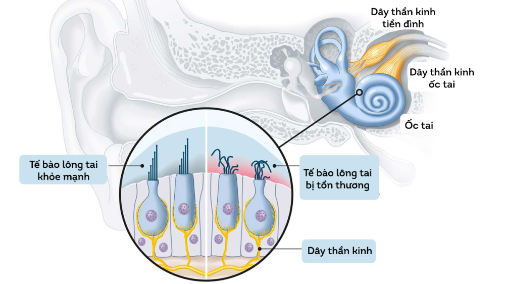 Mất thính lực có thể xảy ra khi tế bào lông trong ốc tai bị tổn thương, không thể chuyển đổi sóng âm thành tín hiệu thần kinh 