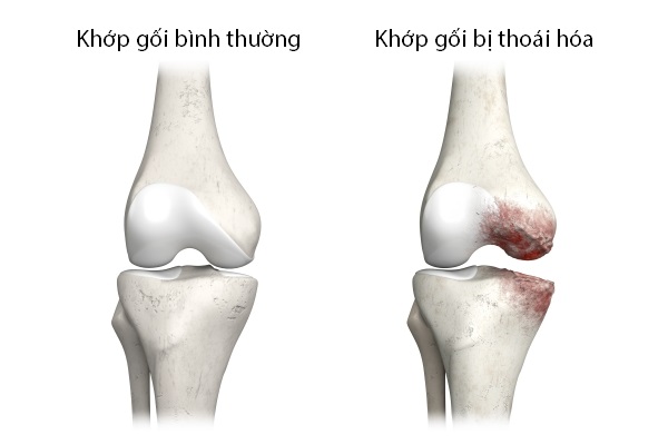 Ảnh minh hoạ tình trạng thoái hoá khớp gối