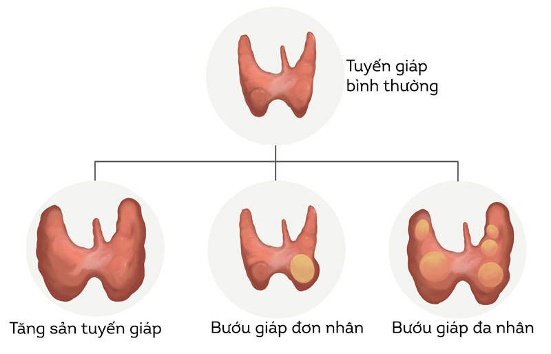 Bướu giáp đa nhân có thể phát triển từ bướu giáp đơn thuần và bướu giáp lan tỏa