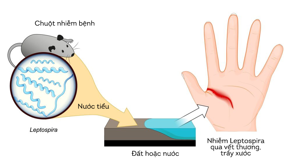 Vi khuẩn Leptospira xâm nhập và gây bệnh cho người qua các vết thương hoặc da bị trầy xước