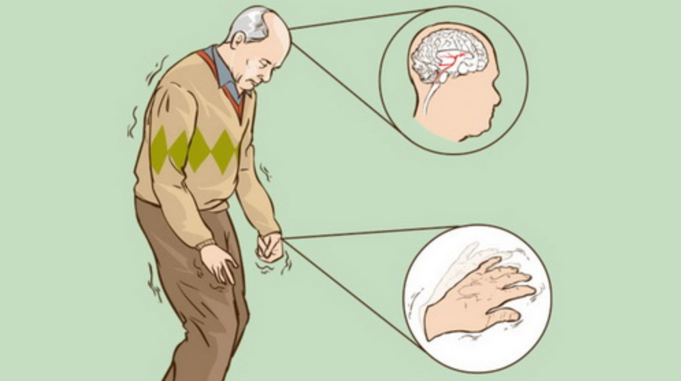 Bệnh Parkinson đặc trưng bởi triệu chứng run tay, gây ảnh hưởng nặng nề tới chất lượng cuộc sống.