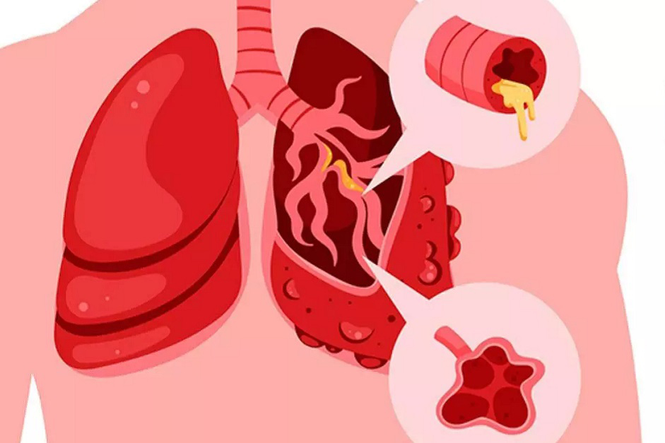 Người bệnh phổi tắc nghẽn mạn tính dễ nhiễm các loại virus và vi khuẩn mùa Đông