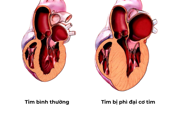 Tiếp xúc với tiếng ồn lớn trong thời gian dài khiến bị dày tim hay phì đại cơ tim.