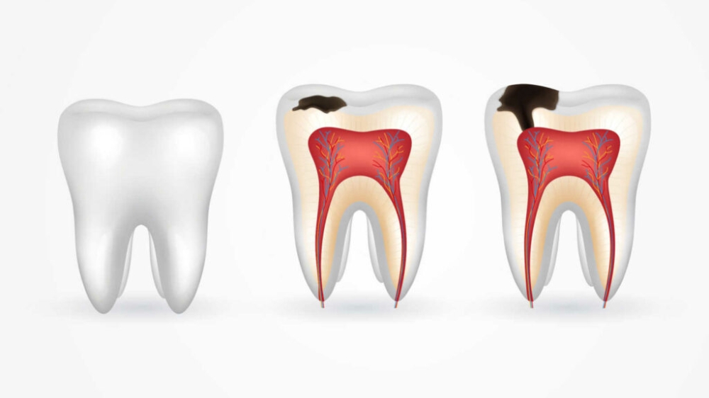 Sâu răng

Sâu răng là nguyên nhân phổ biến gây nên tình trạng buốt răng sau khi ăn đồ ngọt