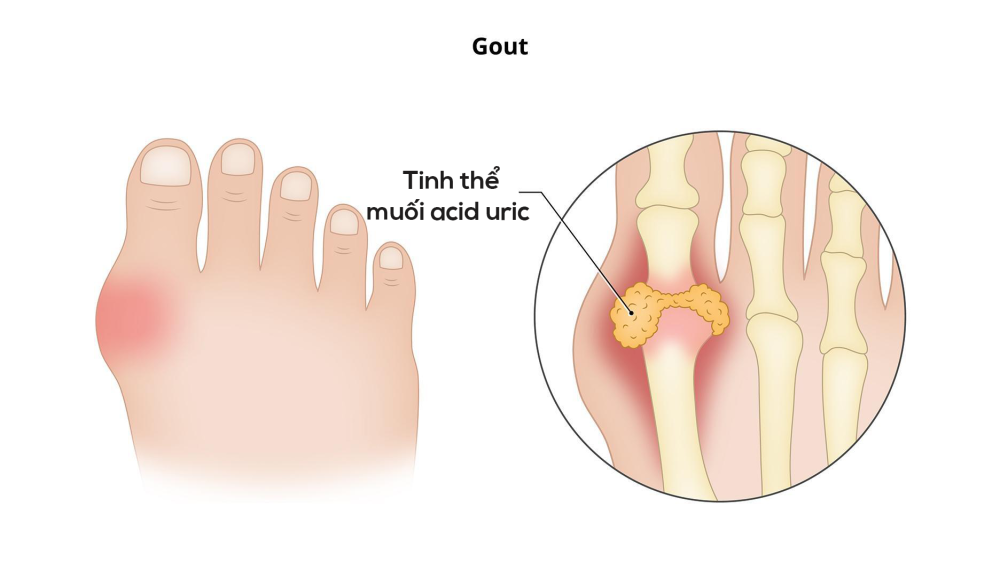 Nồng độ acid uric trong máu tăng cao trong thời gian dài gây ra tình trạng kết tinh tạo thành các tinh thể urat