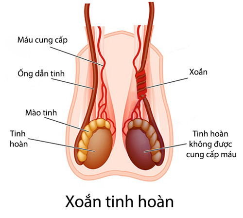 Xoắn tinh hoàn là cấp cứu nam khoa, nếu không xử trí kịp thời có thể dẫn tới vô sinh