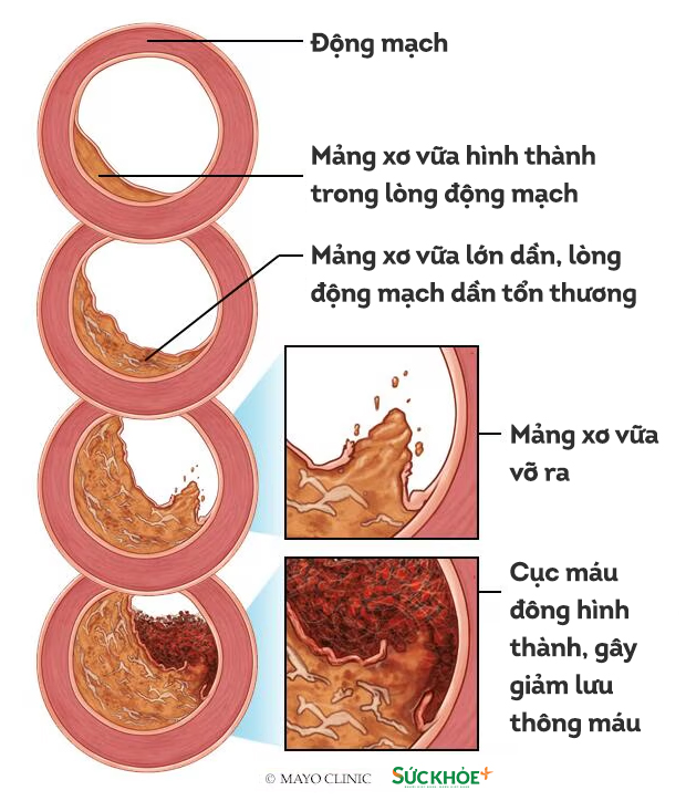 ITKP-xo-vua-dong-mach