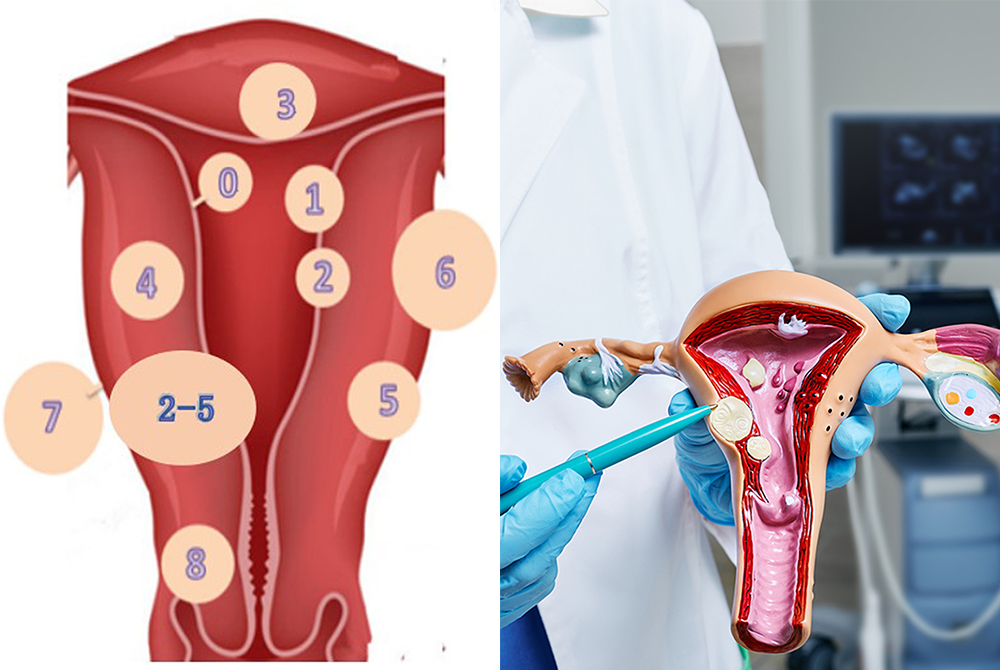 Nhân xơ tử cung loại 4 là loại u xơ có vị trí bên trong cơ tử cung tiếp xúc đồng thời với thanh mạc, niêm mạc tử cung