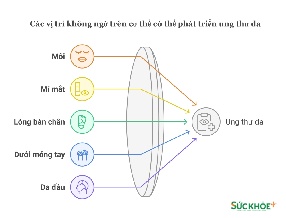 Các vị trí có thể phát triển Ung thư da