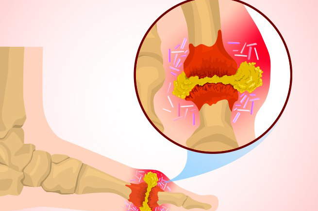 Nguyên nhân gây bệnh gout là do sự rối loạn chuyển hóa acid uric trong cơ thể, có liên quan đến yếu tố di truyền và môi trường sống