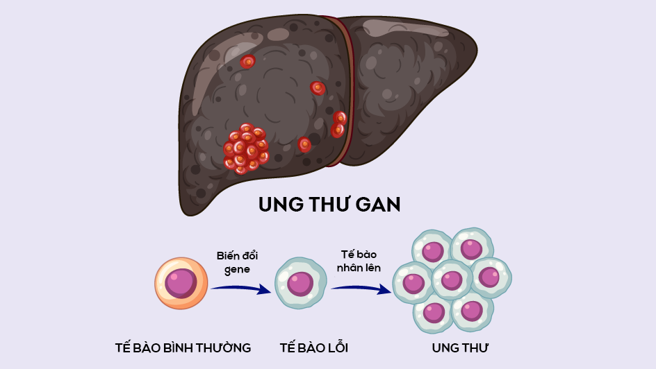 Uống rượu bia thường xuyên làm tổn thương các tế bào gan dẫn đến nguy cơ ung thư gan