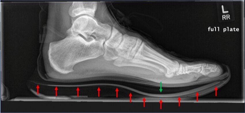 Ảnh chụp X Quang bàn chân trái khi đi giày đế carbon (mũi tên màu đỏ chỉ đường viền của đế, mũi tên màu xanh là điểm đặt lực của bàn chân) - Ảnh: Sports Medicine