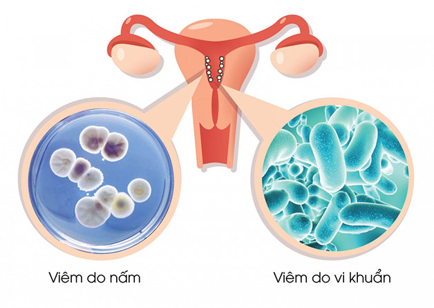 Triệu chứng viêm âm đạo do vi khuẩn: khí hư có mùi tanh cá, có màu trắng, xám, hơi xanh, có thể có bọt nhưng không gây kích ứng hoặc ngứa âm đạo.