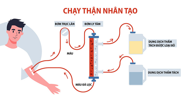 Chạy thận nhân tạo không thể giúp chữa khỏi bệnh suy thận, mà chỉ giúp thực hiện một phần chức năng để duy trì sự sống cho người bệnh