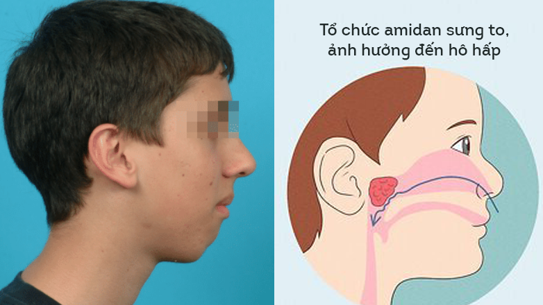 Amidan quá phát bít tắc hô hấp trên gây ngủ ngáy, trẻ ngủ không yên giấc và có gương mặt VA điển hình