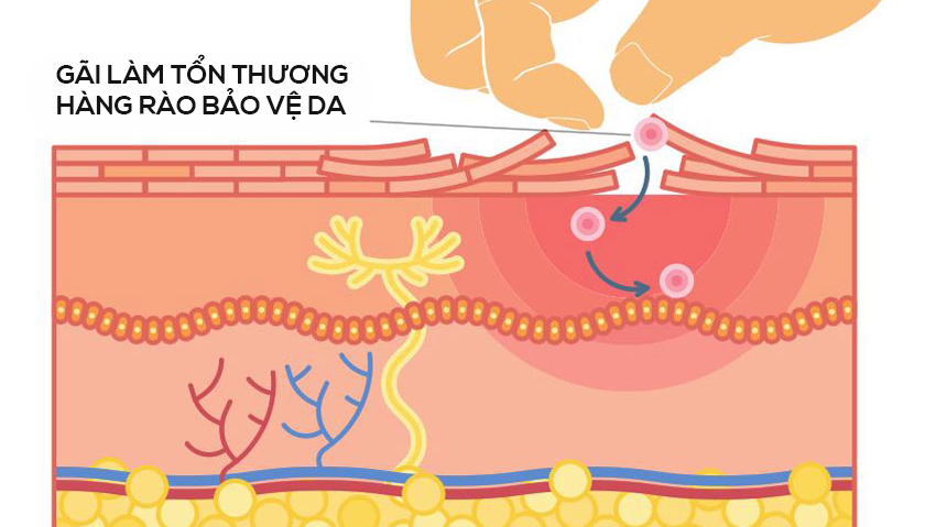 Gãi ngứa có thể khiến triệu chứng mề đay mạn tính trở nên nghiêm trọng hơn