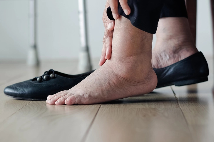 Ngoài phù mặt, người bệnh còn có thể sưng phù chân và đau nhức