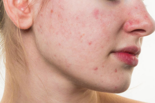 Mụn trứng cá không chỉ do da dầu mà còn nhiều nguyên do khác đi kèm.