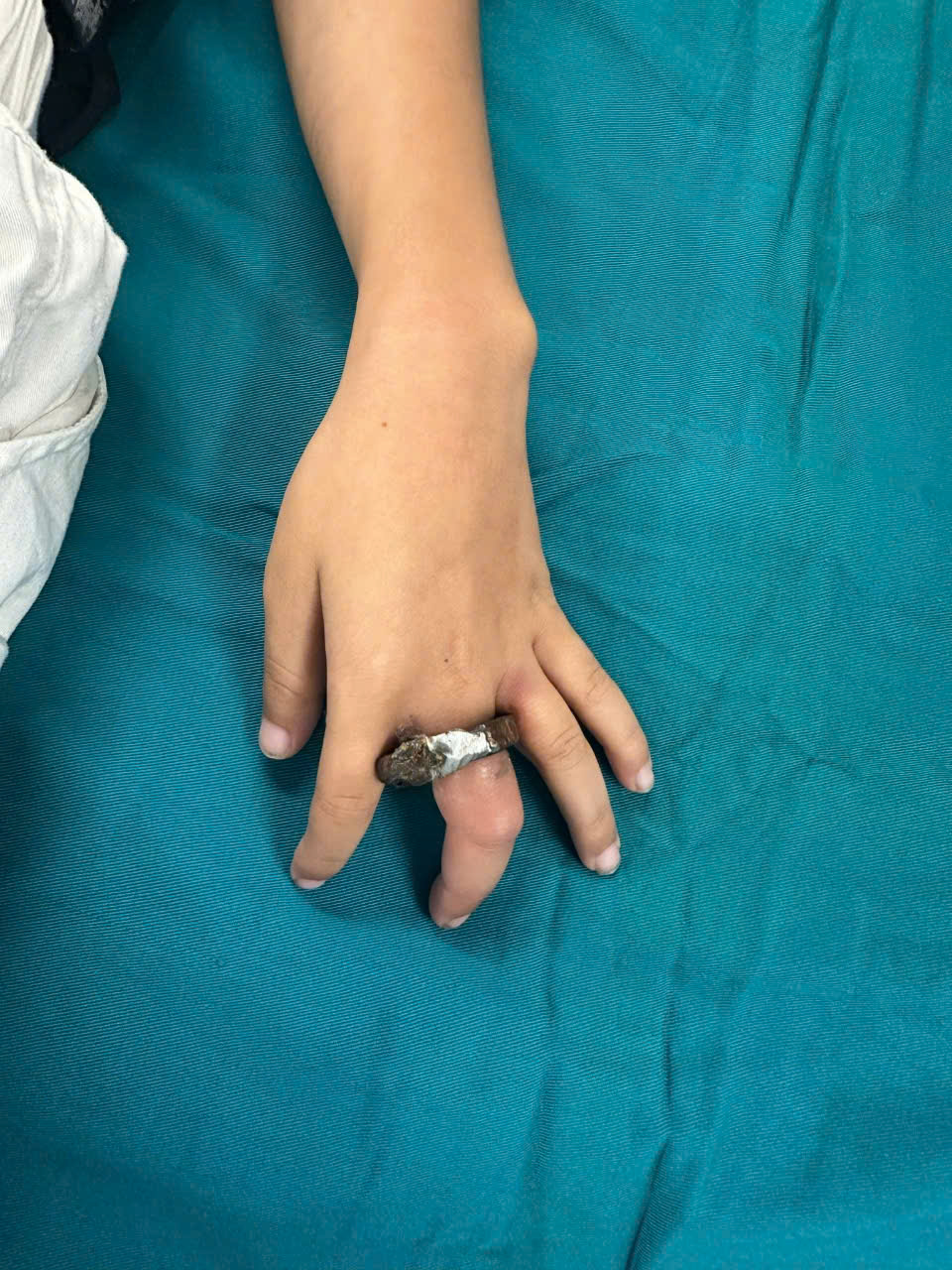 Ngón tay bé tím tái, sưng to do không được lưu thông và có nguy cơ hoại tử - Ảnh: BVCC.