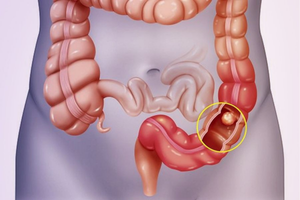 Viêm loét đại tràng là một hiện tượng y khoa không chỉ ảnh hưởng đến sức khỏe mà còn tác động mạnh mẽ đến chất lượng cuộc sống