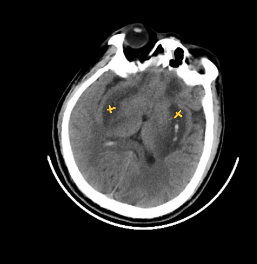Hình ảnh chụp MRI não bệnh nhân: nhân bèo hai bên não bị hoại tử và chảy máu (các vùng đánh dấu) - Ảnh: BVCC