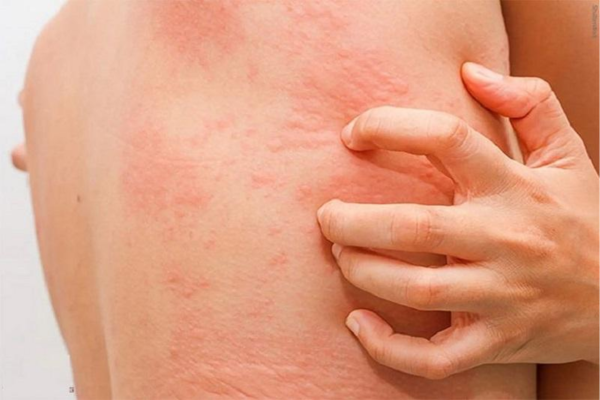 Viêm da dị ứng nổi mề đay gây cảm giác ngứa ngáy khó chịu cho người bệnh