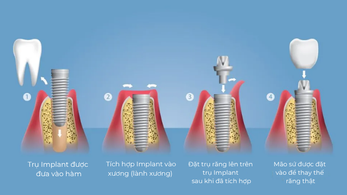Quy trình cấy ghép Implant