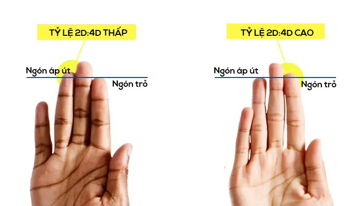 Tỷ lệ 2D:4D thấp là khi ngón áp út cao hơn ngón trỏ.