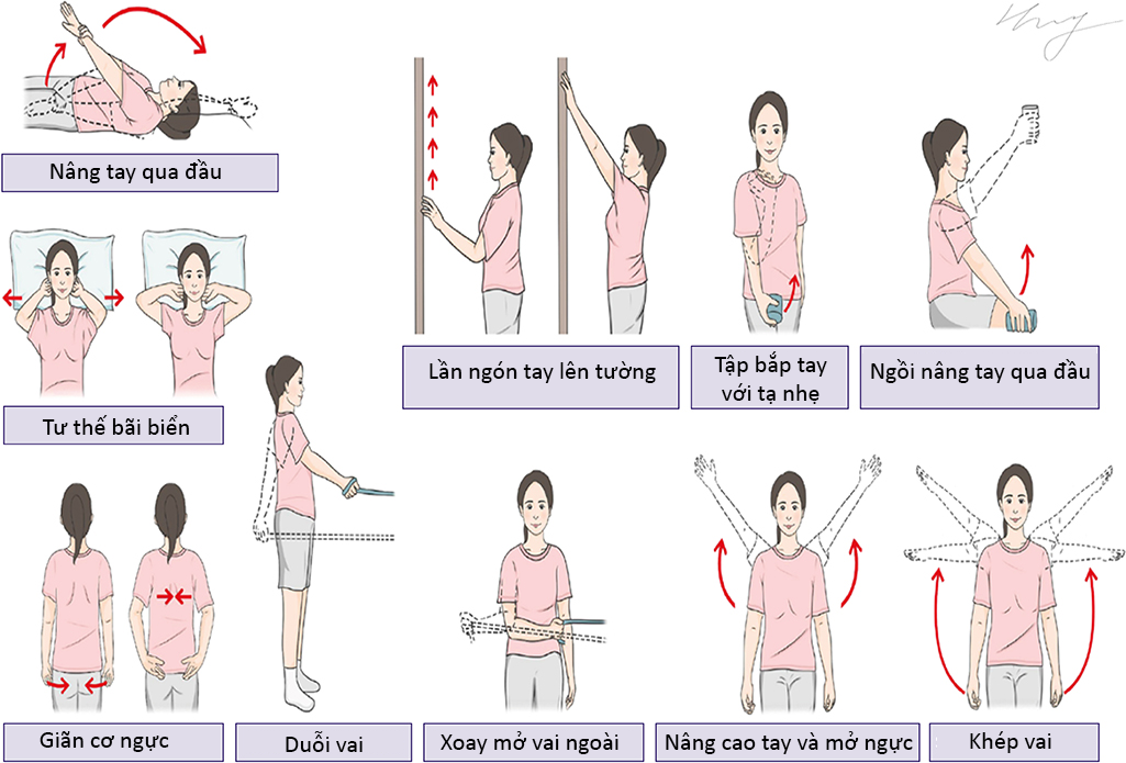 Một vài bài tập hỗ trợ chị em phục hồi sau phẫu thuật cắt bỏ tuyến vú - Ảnh: Tạp chí ung thư vú (Journal of Breast Cancer)