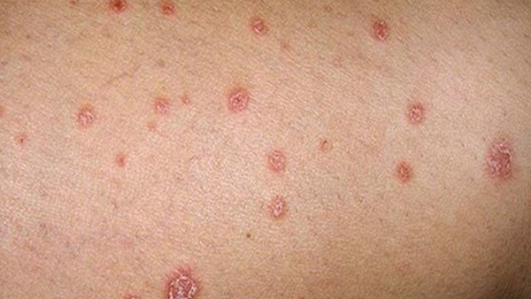 Vảy nến thể giọt xuất hiện rải rác trên cơ thể