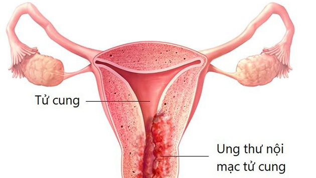 Ung thư nội mạc tử cung - Ảnh: Bệnh viện Sản Nhi Bắc Ninh