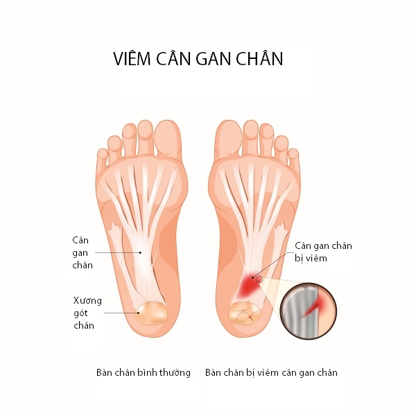 Viêm cân gan chân - Ảnh: Báo Sức khỏe & Đời sống