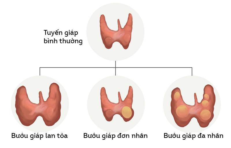 Bướu giáp lành tính gồm ba thể: Thể lan tỏa, thể đơn nhân và thể đa nhân