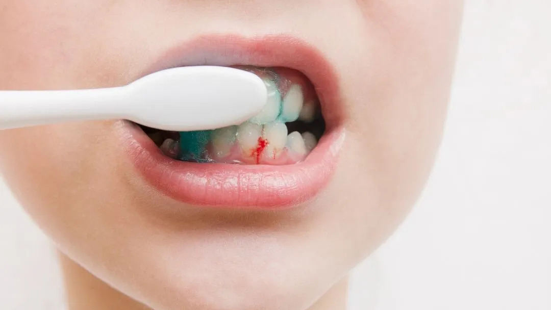 Sử dụng bàn chải lông cứng và đánh răng quá mạnh có thể gây chảy máu chân răng