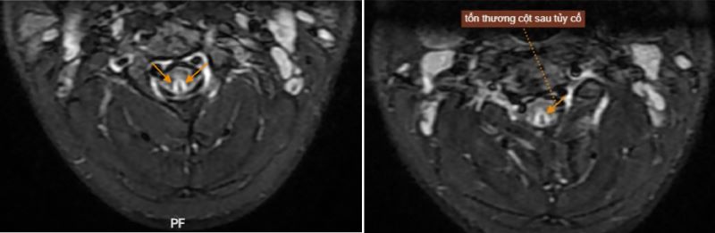 Hình ảnh MRI của bệnh nhân phát hiện tổn thương sau tủy cổ - Ảnh: medlatec.vn