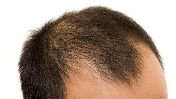 Hói đầu chữ M bắt đầu từ hai bên trán rồi lan dần lên đỉnh đầu là đặc trưng của hói kiểu nam