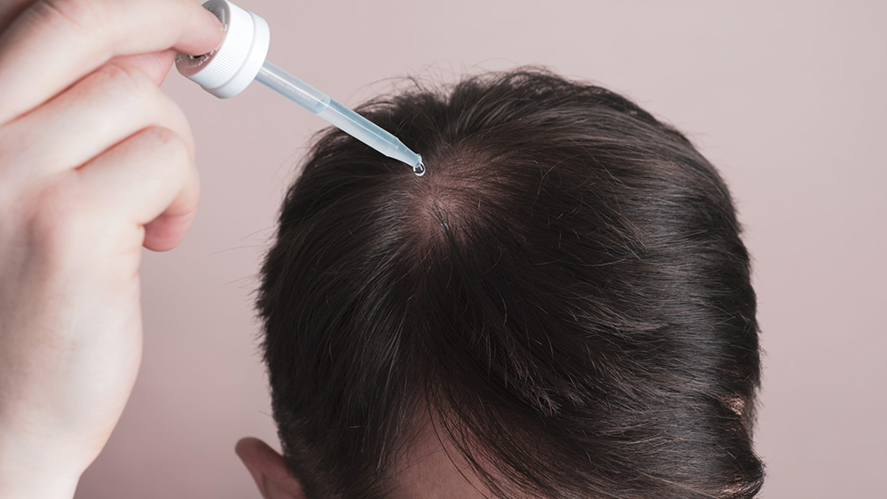 Minoxidil dạng bôi là một trong những phương pháp kích thích mọc tóc phổ biến