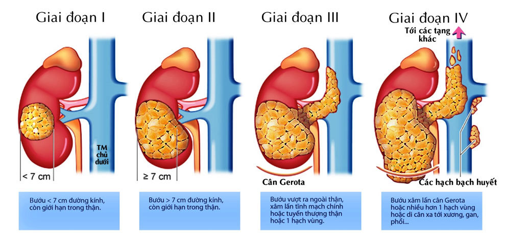 Các giai đoạn tiến triển của bệnh ung thư thận - Anh: BVCC