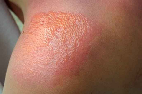 Ngộ độc ánh nắng có thể làm da bỏng rộp, đau rát.