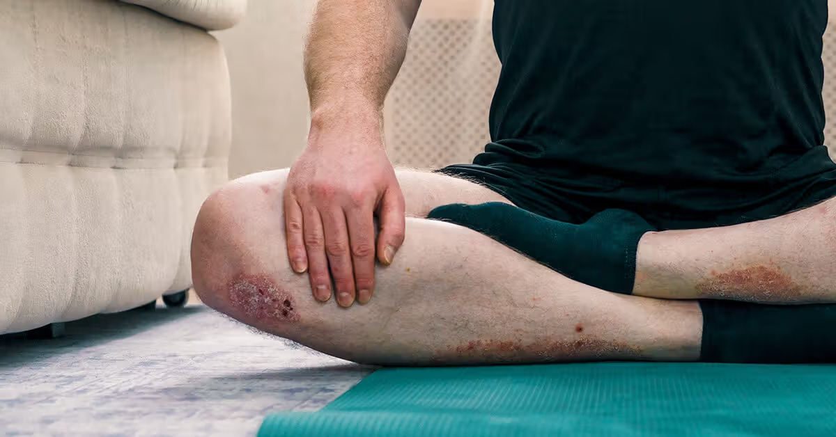 Khớp gối là một trong những vị trí thường bị ảnh hưởng trong các thể viêm khớp vảy nến