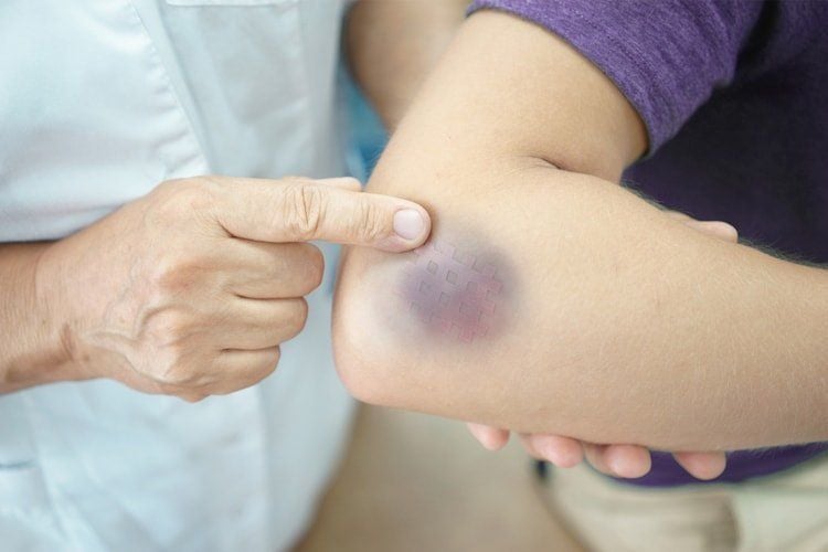 Xoa nhẹ vùng da bị bầm tím có thể giúp máu tụ ở vết bầm tan nhanh hơn