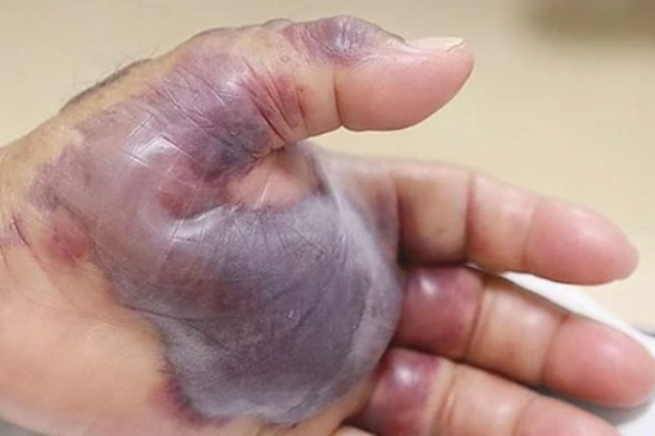 Bàn tay của người đàn ông 71 tuổi ở Hàn Quốc sau 12 giờ ăn phải hải sản sống và bị nhiễm vi khuẩn “ăn thịt người” Vibrio vulnificus - Ảnh: NEW ENGLAND JOURNAL OF MEDICINE