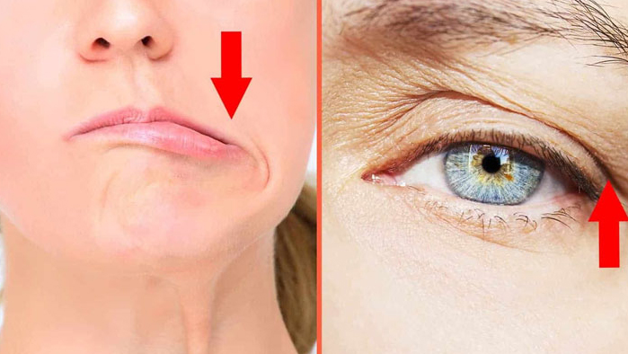 Tiêm Botox không đúng kỹ thuật, liều lượng có thể gây biến dạng khuôn mặt