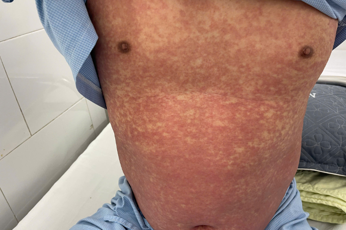 Hình ảnh phát ban toàn thân trên bệnh nhân dị ứng thuốc nặng do Phenylbutazone đang được điều trị tại Trung tâm Dị ứng & Miễn dịch lâm sàng - Ảnh: BVCC.