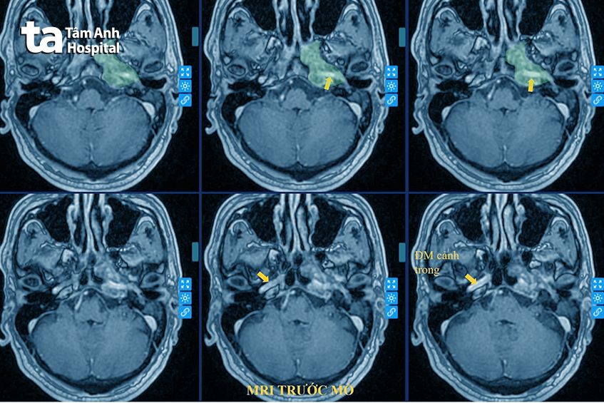 Ảnh chụp MRI khối u nằm sâu trong vùng xương đá - Ảnh: Bệnh viện Đa khoa Tâm Anh
