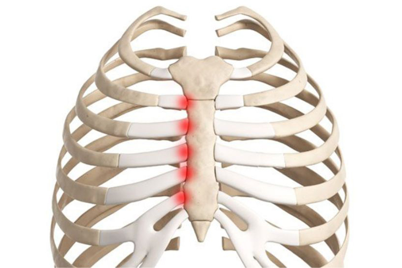 Viêm sụn sườn gây ra cơn đau ngực, thường nhói và tăng khi vận động hoặc thở sâu